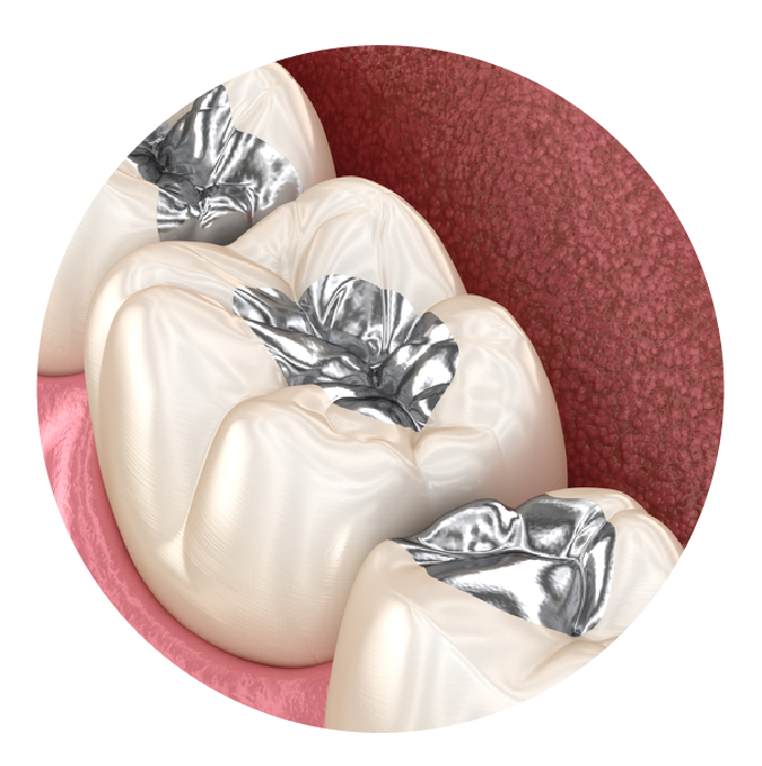 silver-fillingArtboard 1